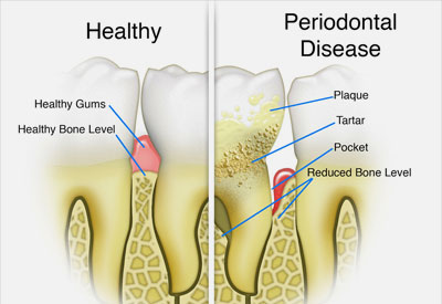 tooth and bone loss graphic