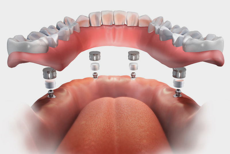 ball retained dentures graphic