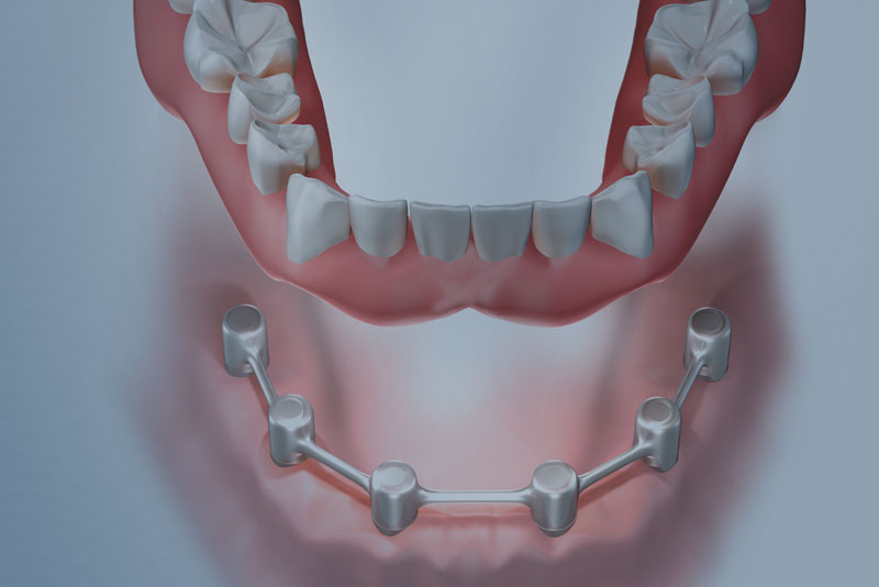bar retained implant supported dentures graphic