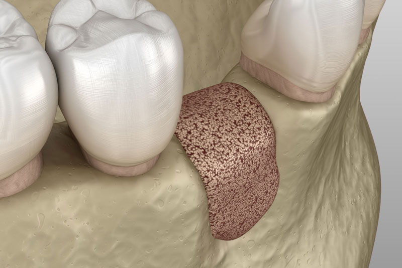 bone graft graphic