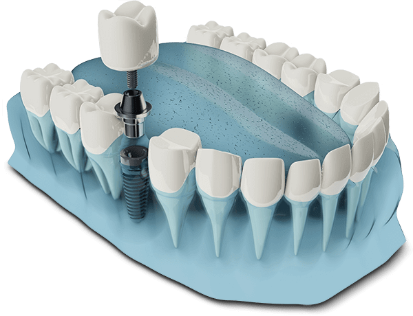 dental implant graphic