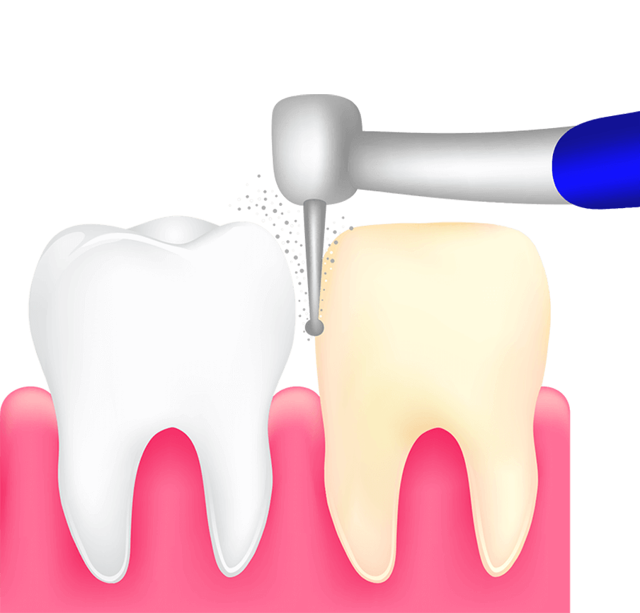 dental crown process graphic