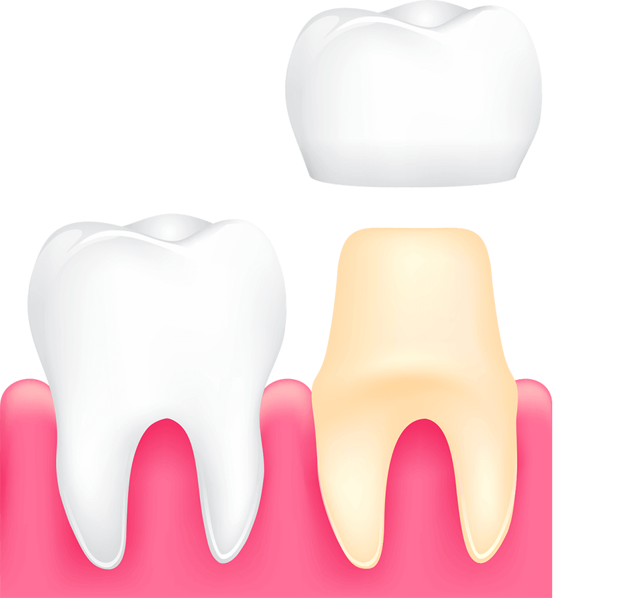 dental crown process graphic