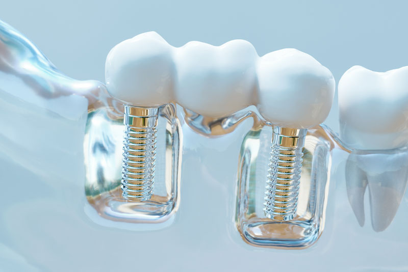 dental implant bridge model