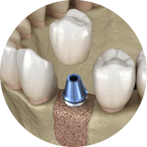 dental implant graphic