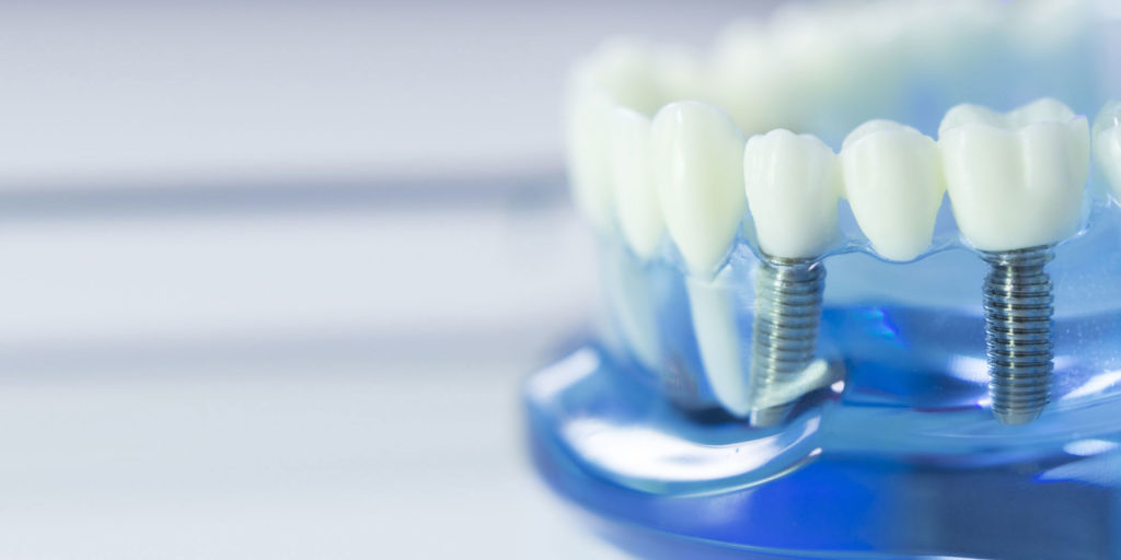 dental implant model