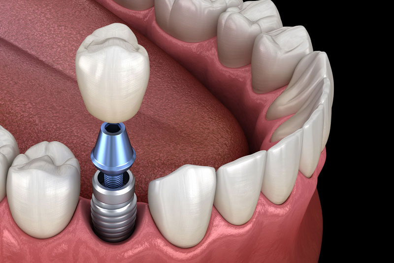 dental implant model