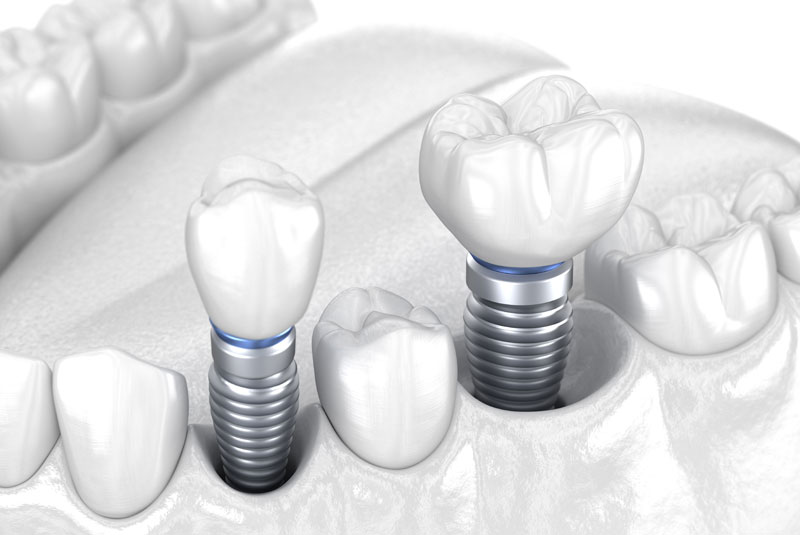 dental implants model