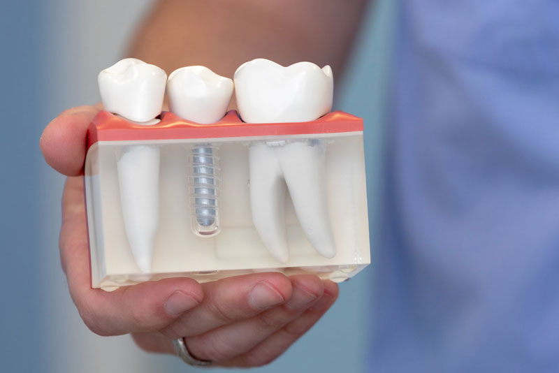 dental implants model