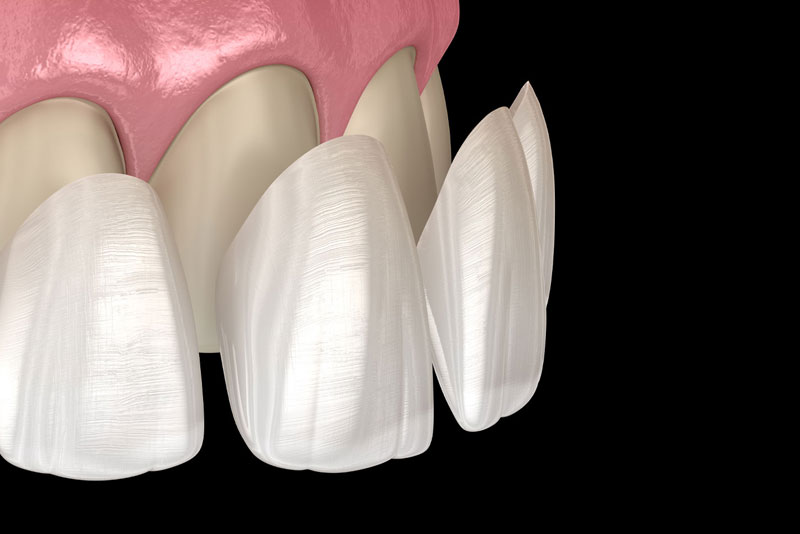dental veneers graphic