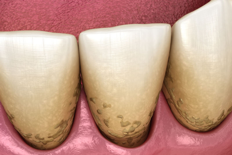 gum disease graphic