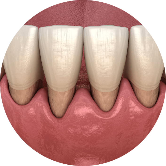 gum recession graphic