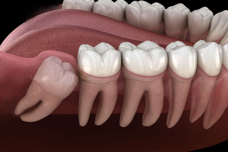 impacted tooth graphic