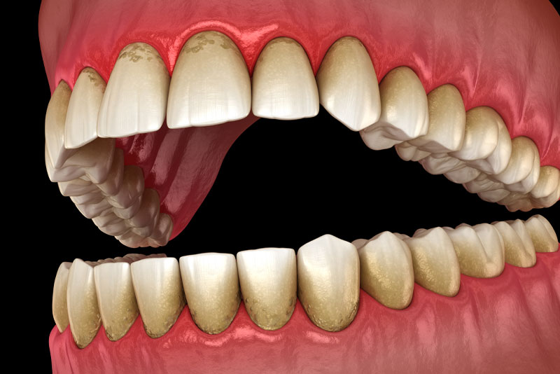 periodontal disease graphic
